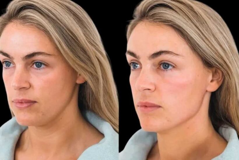 Cheek Filler Glow Rise, Sculpted Confidence and Youthful Contours in Dubai