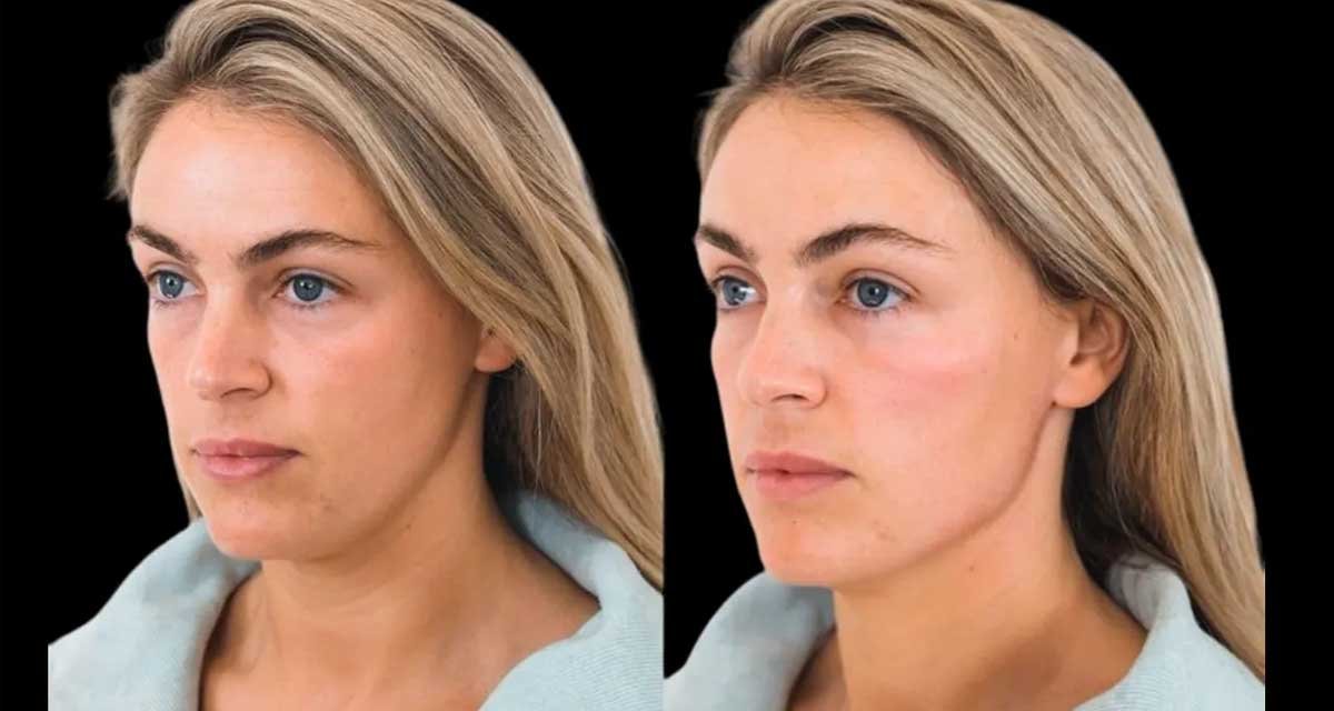 Cheek Filler Glow Rise, Sculpted Confidence and Youthful Contours in Dubai