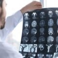 How Brain Injuries Impact Long-Term Compensation in Toronto