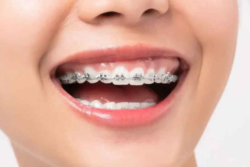 Direct-vs.-Indirect-Bonding-Which-is-Better