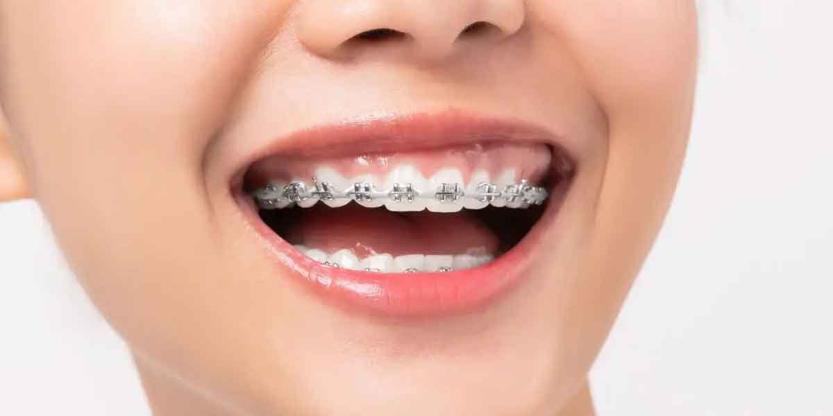 Direct-vs.-Indirect-Bonding-Which-is-Better