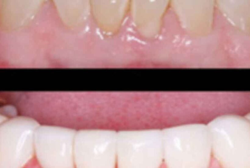 Investing-in-Your-Smile-Why-Prevention-is-Cheaper-Than-a-Crown