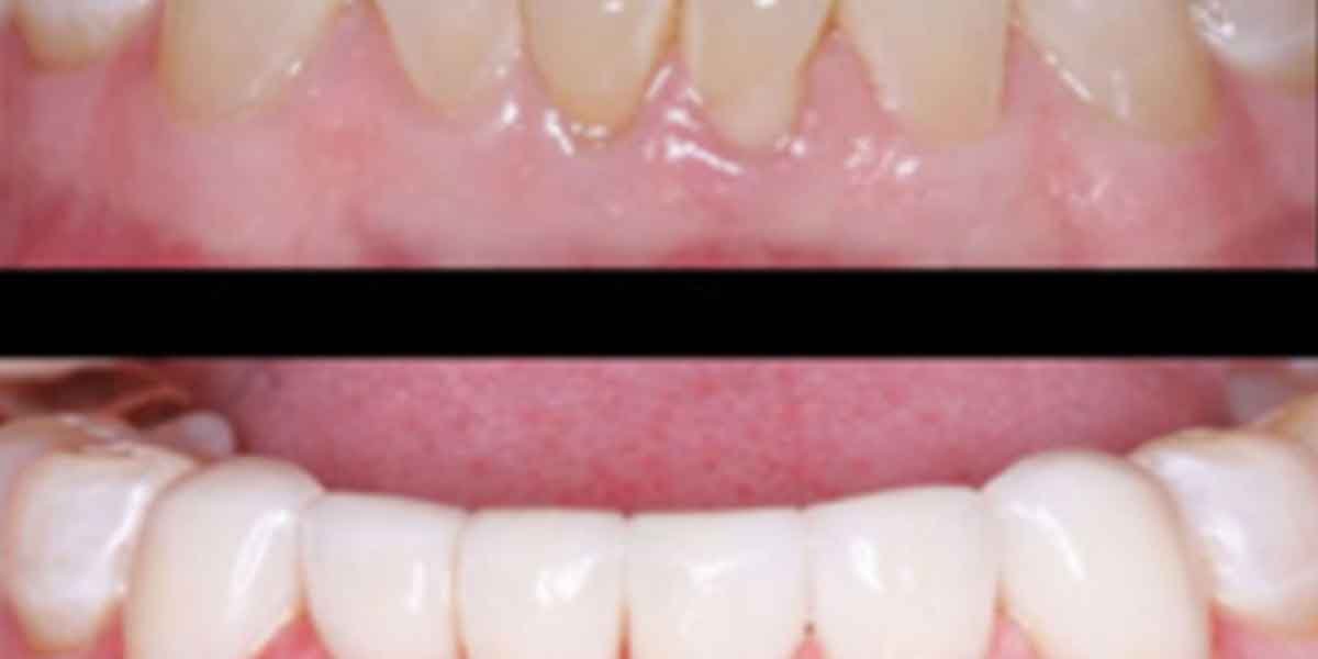 Investing-in-Your-Smile-Why-Prevention-is-Cheaper-Than-a-Crown