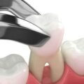 The Impact of Wisdom Teeth on Oral Health
