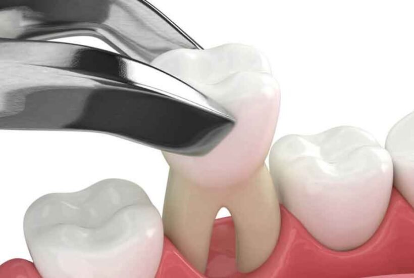 The Impact of Wisdom Teeth on Oral Health
