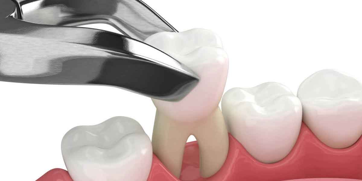 The Impact of Wisdom Teeth on Oral Health