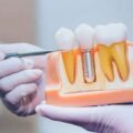 The Long-Term Value of Investing in Dental Implants