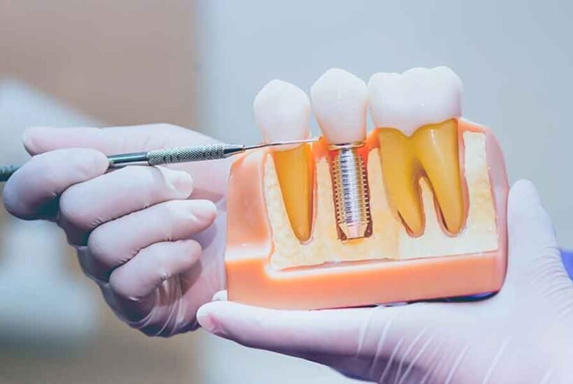 The Long-Term Value of Investing in Dental Implants