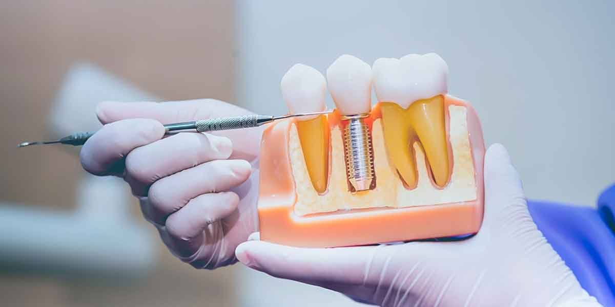 The Long-Term Value of Investing in Dental Implants