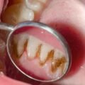 What-is-Gingivitis-How-to-Spot-and-Treat-Early-Gum-Disease