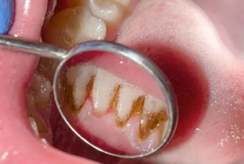 What-is-Gingivitis-How-to-Spot-and-Treat-Early-Gum-Disease