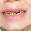 Toddler Tooth Decay: How to Spot the Early Signs and Stop It