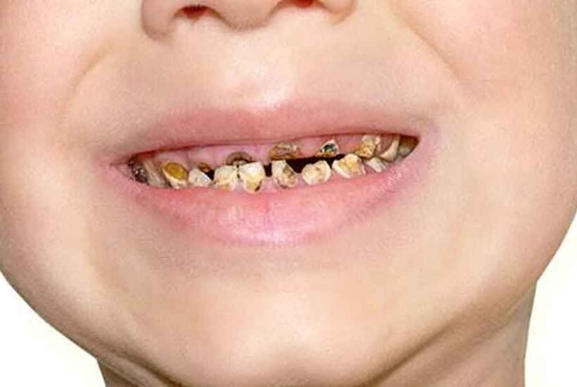 Toddler Tooth Decay: How to Spot the Early Signs and Stop It