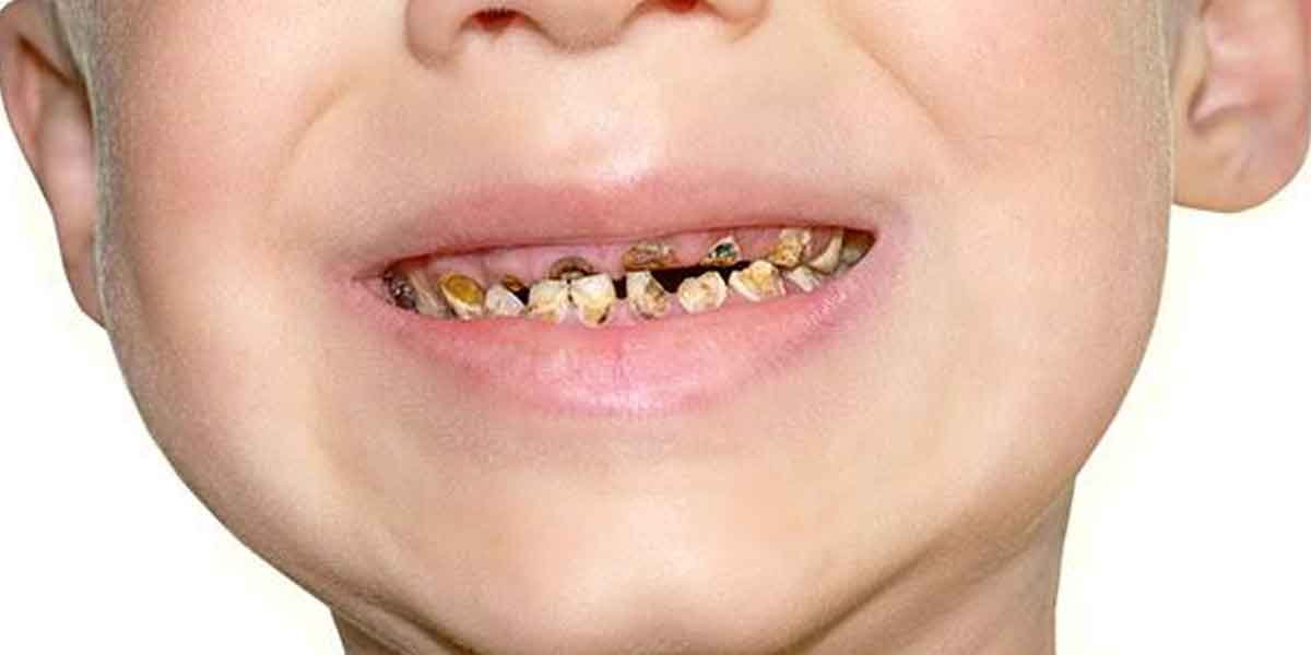 Toddler Tooth Decay: How to Spot the Early Signs and Stop It