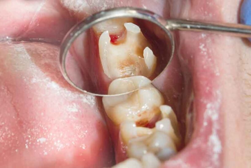 What to Do If You Have Sensitive Teeth