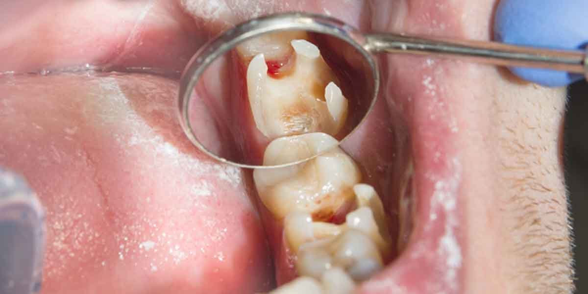 What to Do If You Have Sensitive Teeth