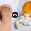 topical-formula-for-nail-fungus-vs-oral-treatments-1