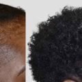 Afro Hair Transplant