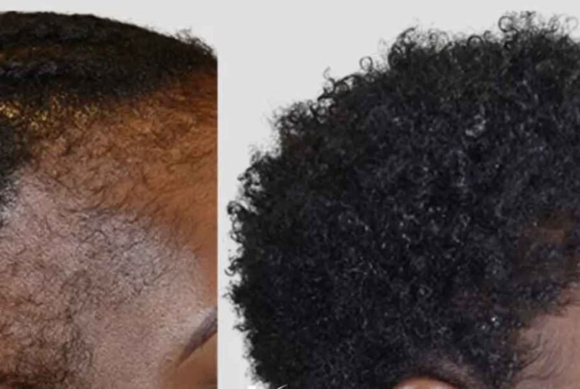 Afro Hair Transplant